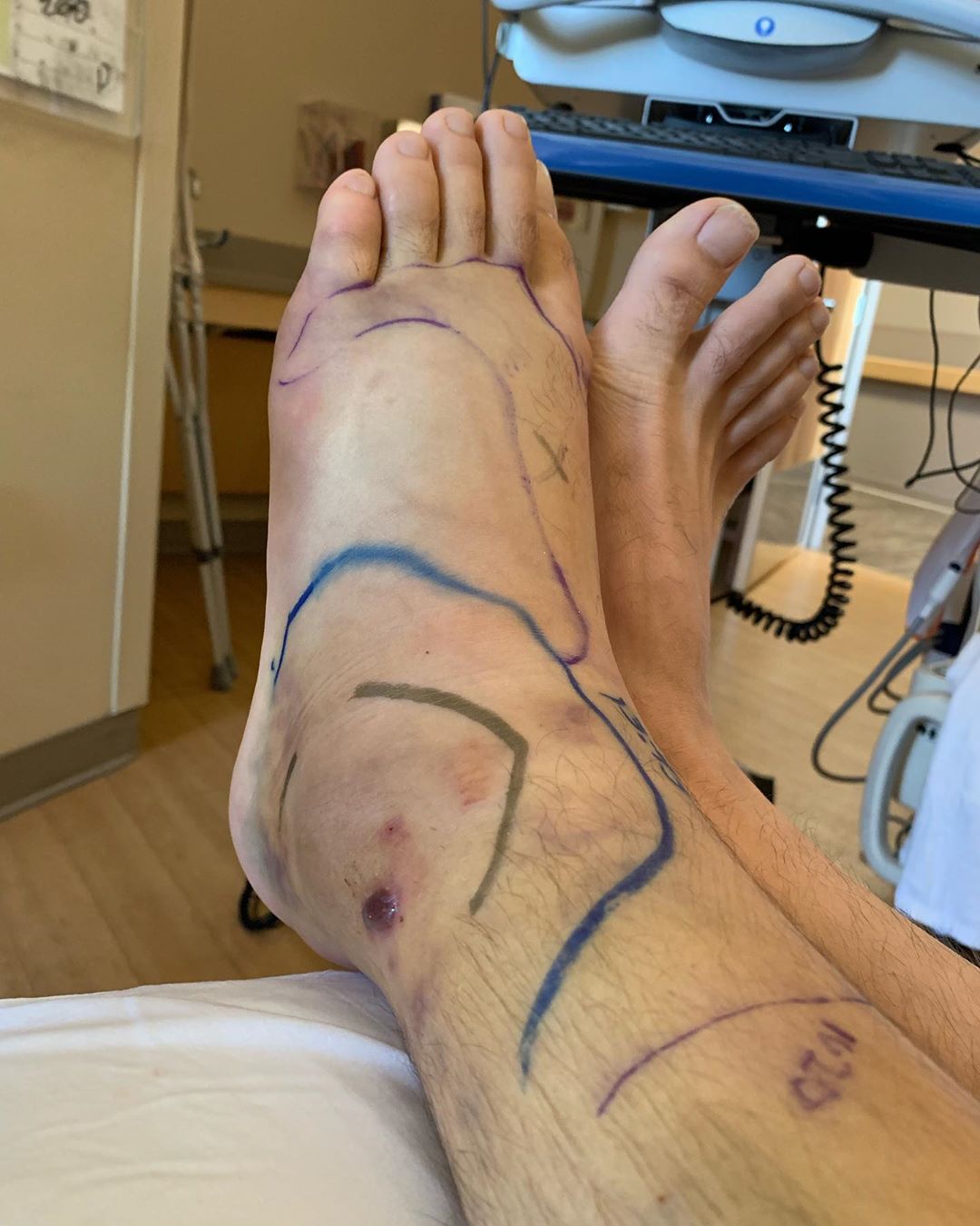 Mike Posner in a hospital in Colorado after a rattlesnake bit his left ankle on August 7, 2019.
